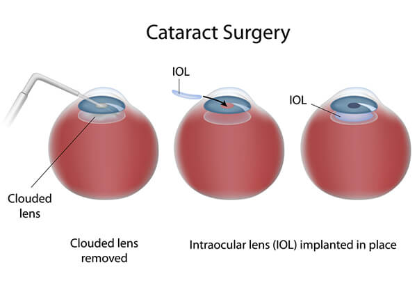 Cataract Surgery Freehold