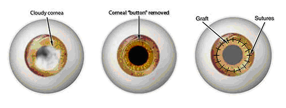 Cornea Transplant Toms River