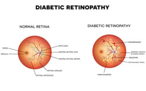diabetc-retinopathy