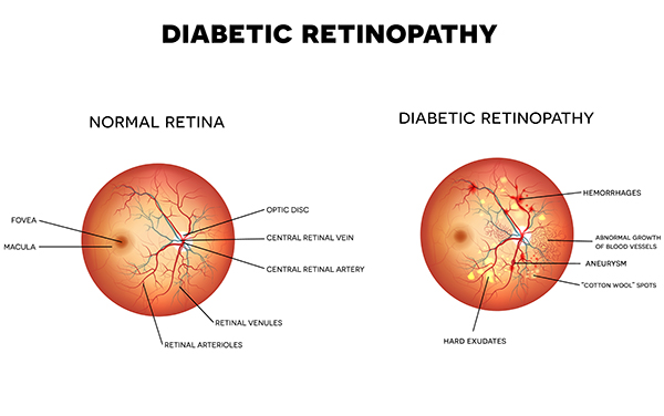 Diabetic Retinopathy Freehold