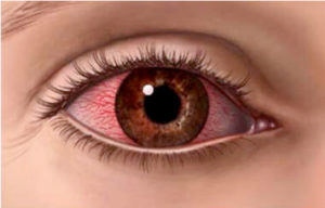 Dry Eye