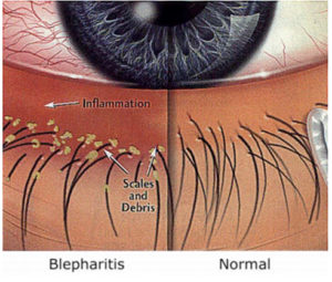 Blepharitis