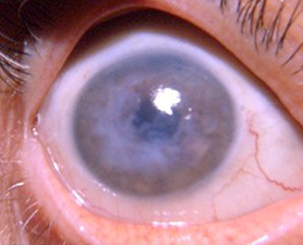 corneal degeneration treatment