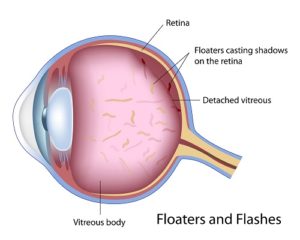 Flashes and Floaters Freehold