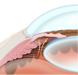 Glaucoma Freehold, New Jersey