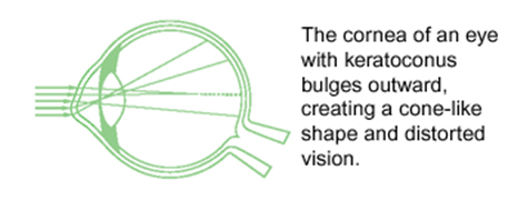 Keratoconus Toms River