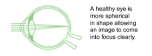 Keratoconus