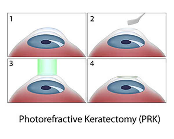 Photorefractive Keratectomy (PRK) Freehold 