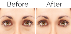 Blepharoplasty Freehold