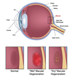 Macular Degeneration Freehold