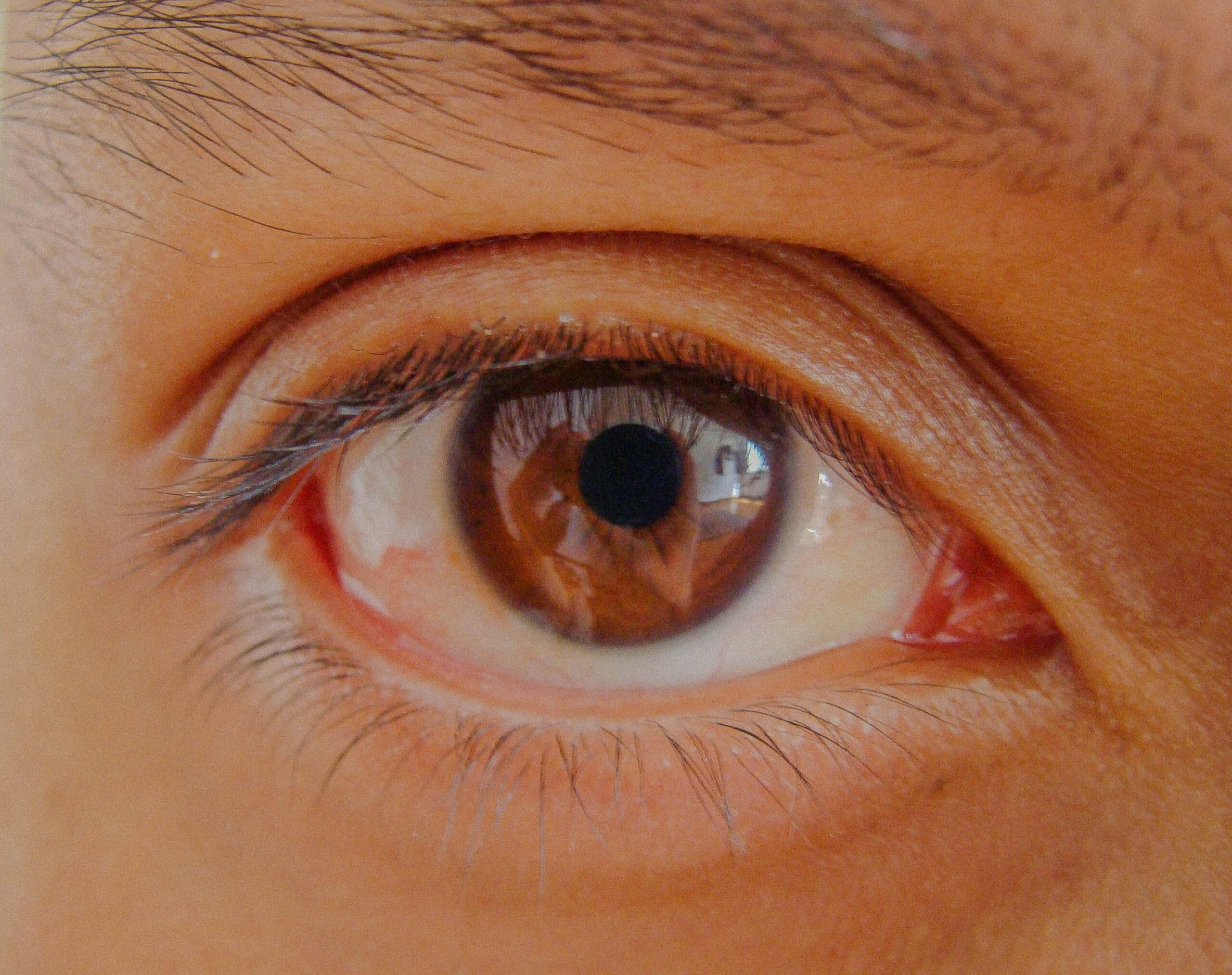 Intacs® Corneal Implants Brick, New Jersey